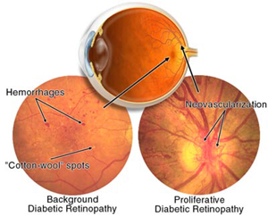 Diabetic Retinopathy