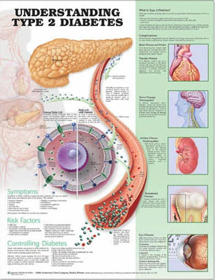 Type-2-Diabetes-medical-anatomical-chart